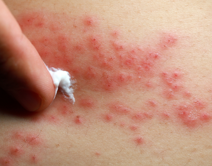 Close-up of dry, itchy eczema rash on human skin