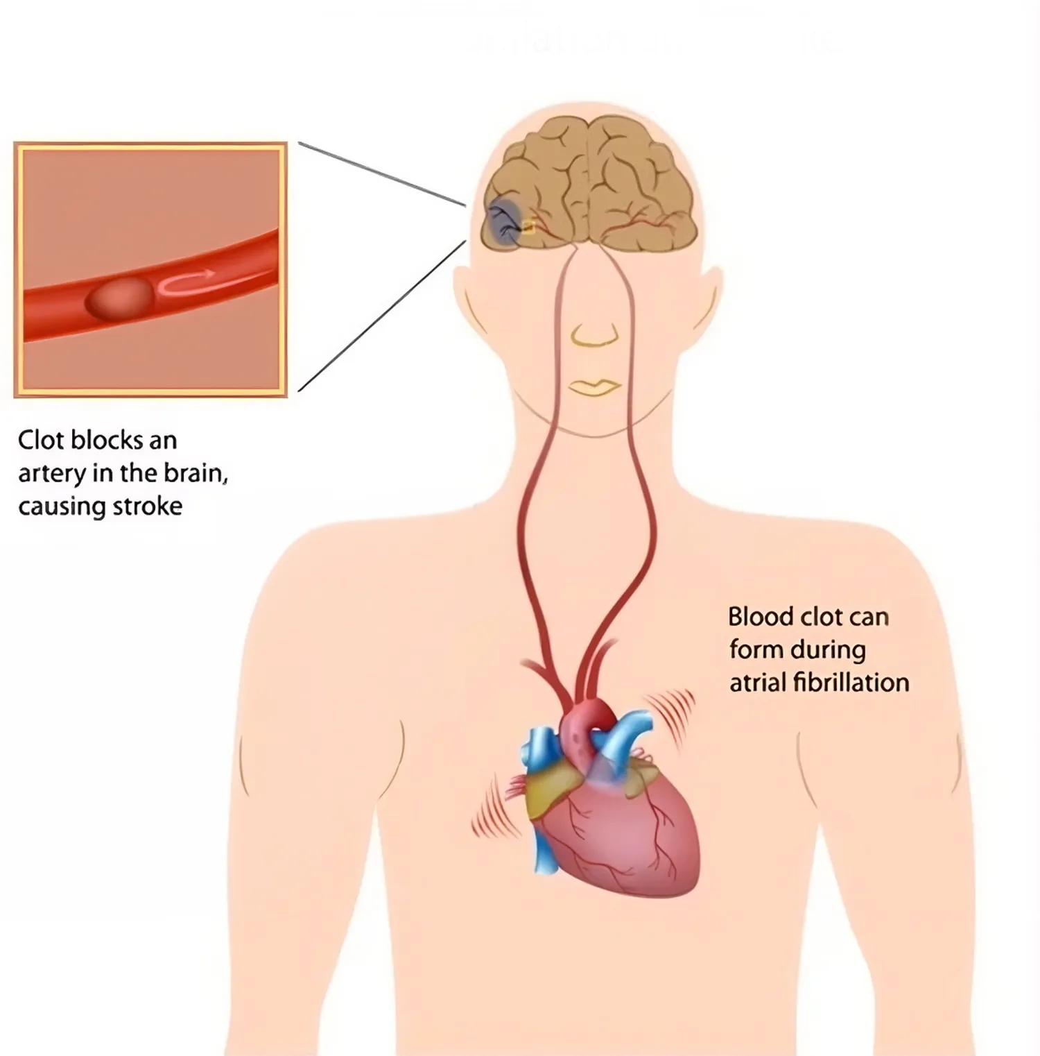 atrial fibrillation